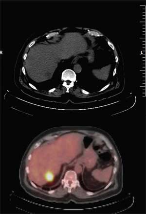 Fig 4. Hombre con cáncer colo-recta l. Status post hemicolectomía y quimioterapia adyuvant e. Presenta aumento en CEA. PET-CT detecta lesión hipodensa e hipermeta bólica en el hígado