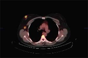Fig 2. Pa ciente de 45 años recién diagnosticada con cáncer de mama. PET-CT con propósito de esta dio: Confirma tumor primario y demuestra metástas is a ganglio axilar.