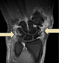 MRI DE RODILLA CON ALTERACIÓN INFLAMATORIA.