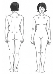Puntos de dolor a la presión para diagnóstico de fibromialgia.
