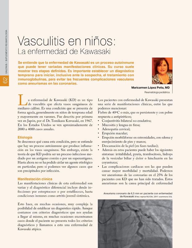 Vasculitis en niños: La enfermedad de Kawasaki 