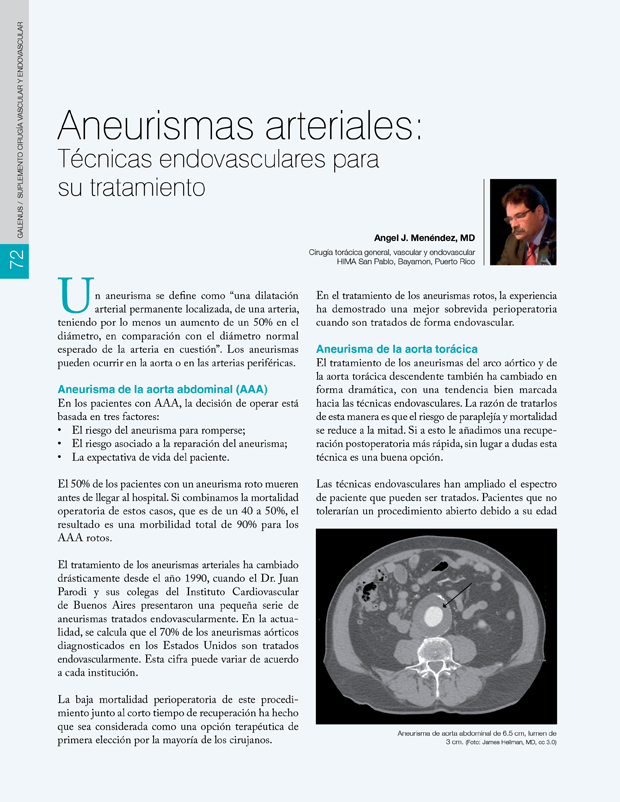 Aneurismas arteriales: Técnicas endovasculares para su tratamiento 