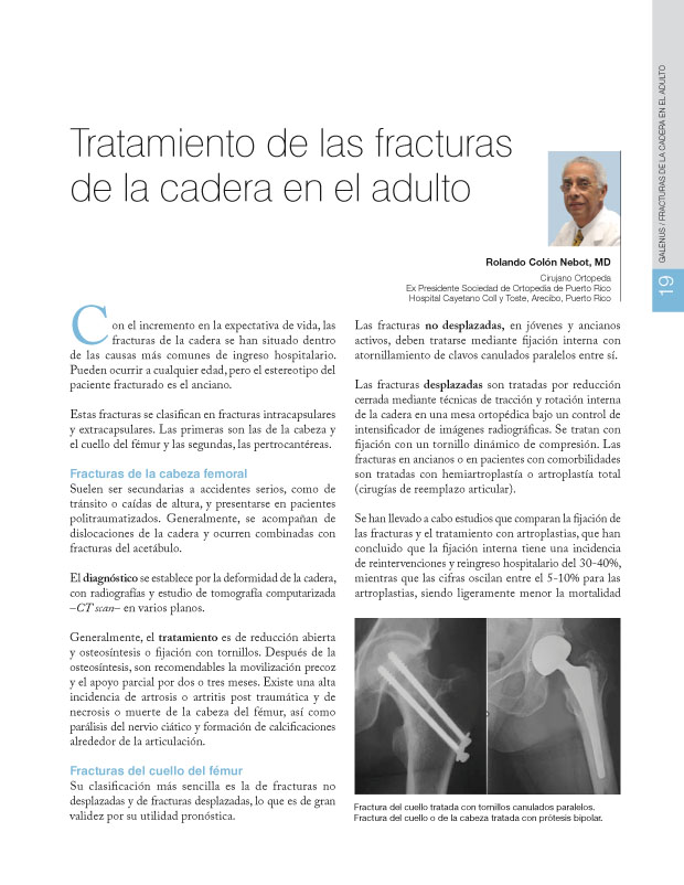 Tratamiento de las fracturas de la cadera en el adulto 