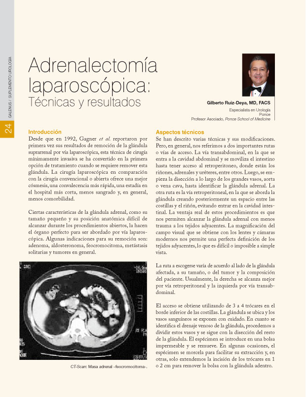 Adrenalectomía laparoscópica: 