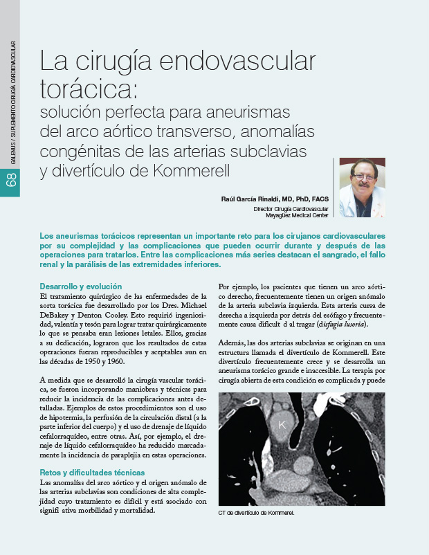 La cirugía endovascular torácica: solución perfecta para aneurismas del arco aórtico transverso, anomalías congénitas de las arterias subclavias y divertículo de Kommerell 