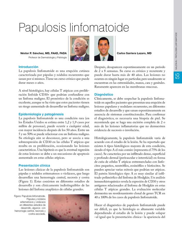 Papulosis linfomatoide 