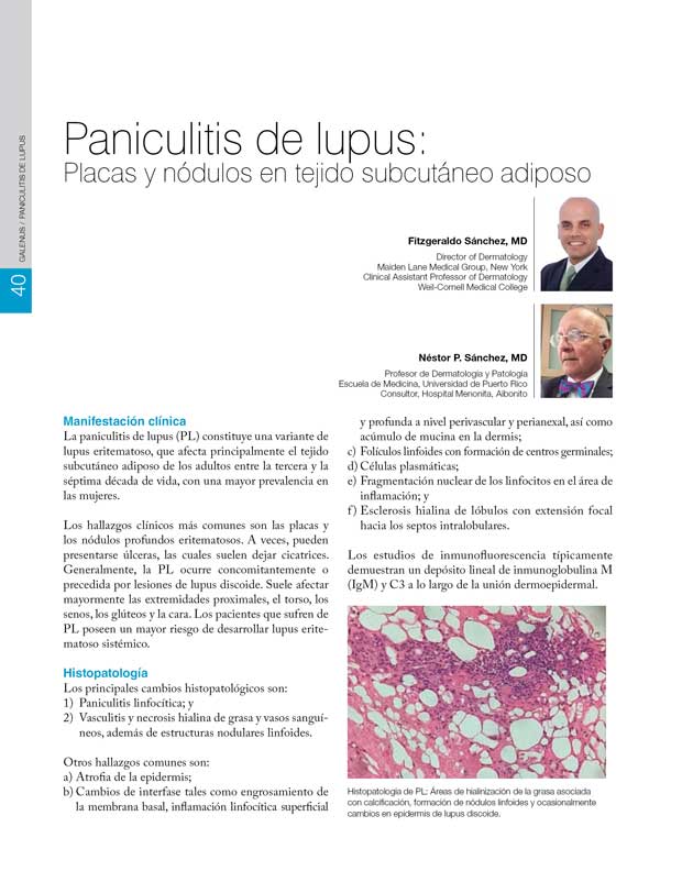 Paniculitis de lupus 