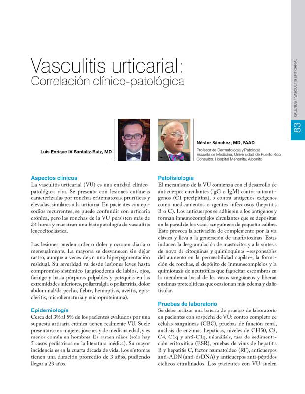 Vasculitis urticarial 
