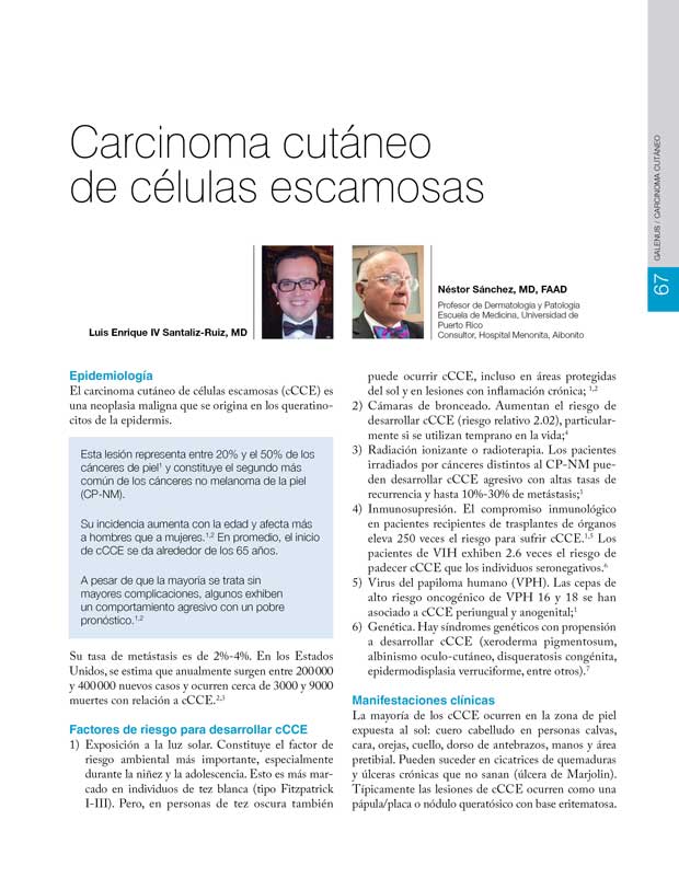 Carcinoma cutáneo  de células escamosas 