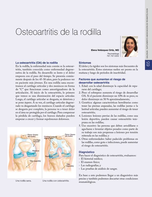 Osteoartritis de la rodilla 