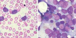 Leucemia mielógena aguda. Aspirado medular muestra leucemia mieloide aguda. (foto: Vashi Donsk, GFU Free documentation Licence 1.2) izq. / Leucemia linfocítica crónica: Lámina de sangre periférica en mujer de 70 años con cuenta absoluta de 41 000 uL linfocitos (foto Creatve Commons 2.0,Ed Uthman) der.