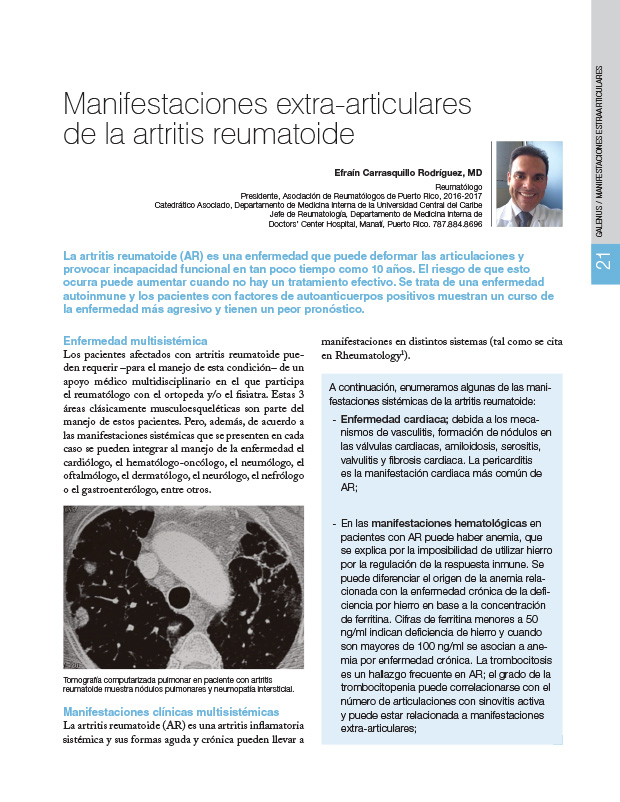 Manifestaciones extra-articulares de la artritis reumatoide